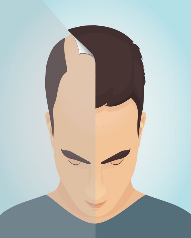 Hair Transplant Karachi Pakistan Treatment Clinic