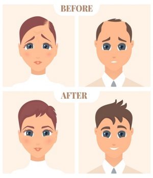 Male and female pattern hair loss set. Baldness treatment result in men and women. Before and after concept. Alopecia infographic medical vector template for clinics and diagnostics centres.