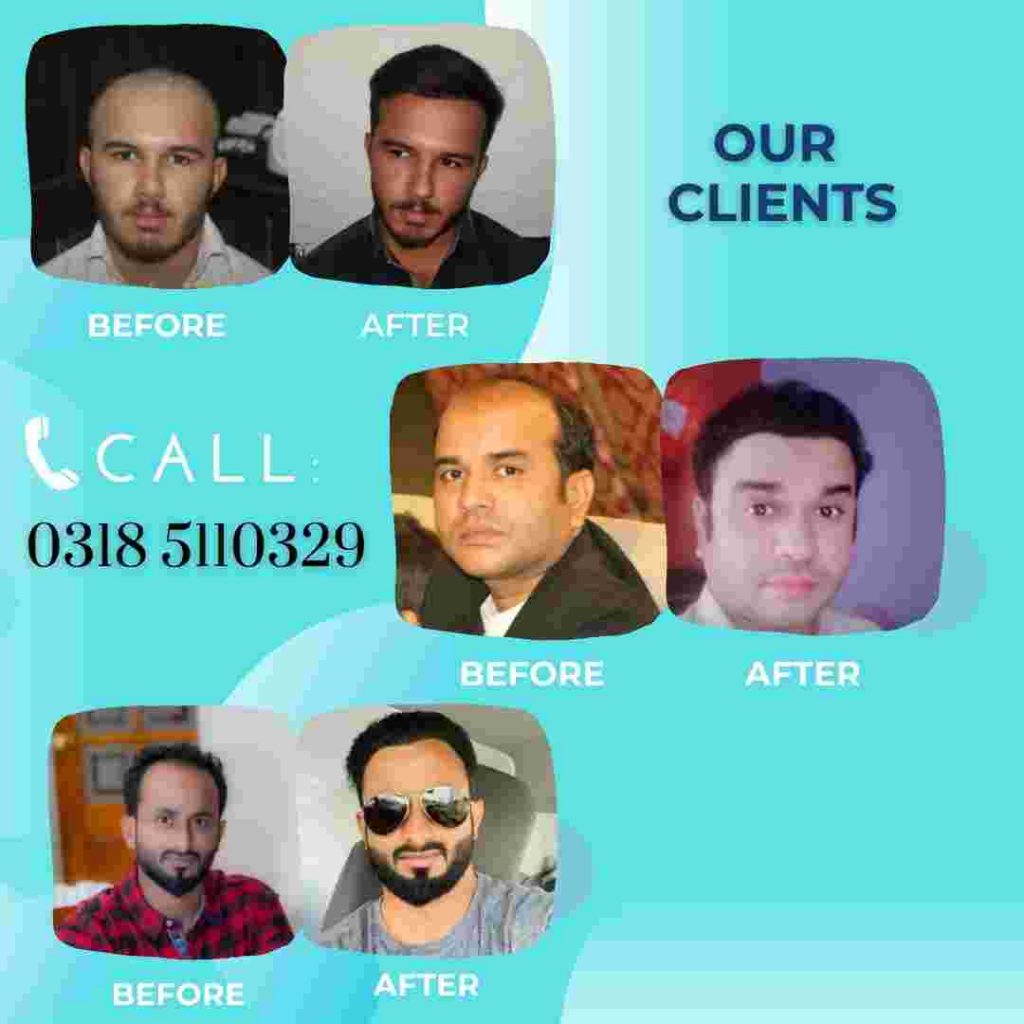 Before and after Results of Gair Transplant Karachi
